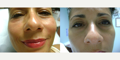 Botox before and after photo