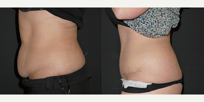 Tummy Tuck before and after photo
