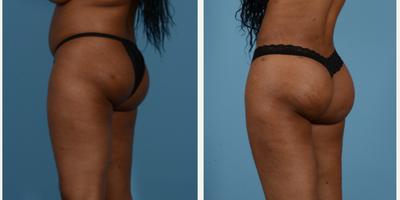 Brazilian Butt Lift before and after photo