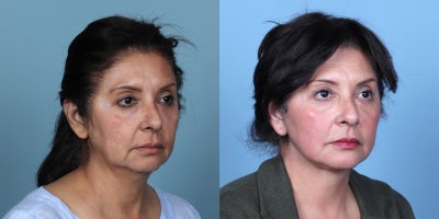 Facelift before and after photo