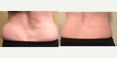 CoolSculpting before and after photo