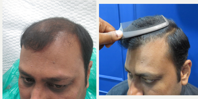 FUE Hair Transplant before and after photo