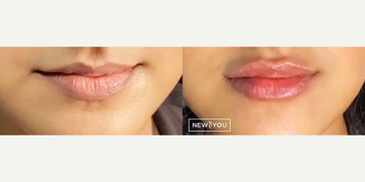 Lip Fillers before and after photo