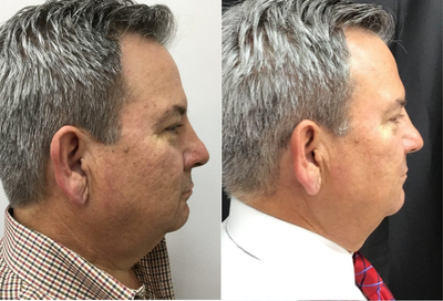 Microneedling RF before and after photo