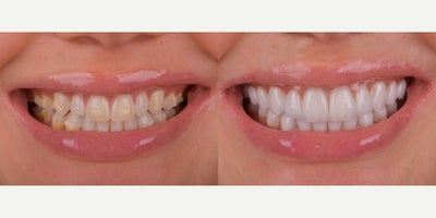 Porcelain Veneers before and after photo