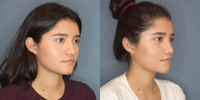 Rhinoplasty before and after photo