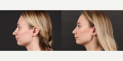 Rhinoplasty before and after photo