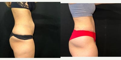 Tummy Tuck before and after photo