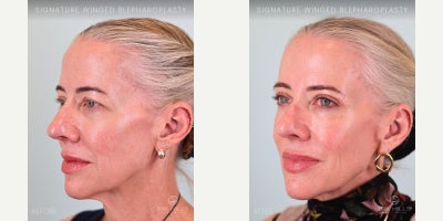 Eyelid Surgery before and after photo