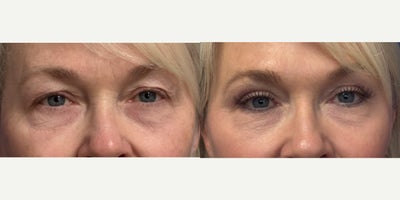 Eyelid Surgery before and after photo