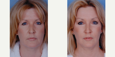 Facelift before and after photo