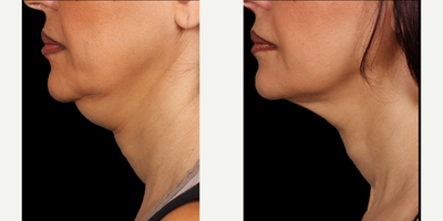Kybella before and after photo