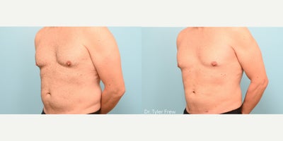 Liposuction before and after photo