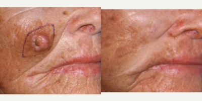 Skin Rejuvenation before and after photo
