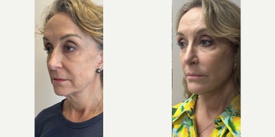 Brow Lift before and after photo