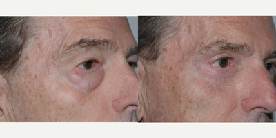 Eyelid Surgery before and after photo