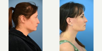 Facelift before and after photo