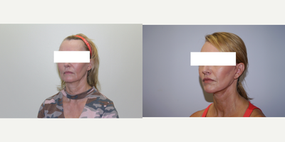 Neck Lift before and after photo