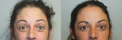 Botox before and after photo