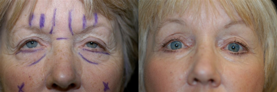 Brow Lift before and after photo