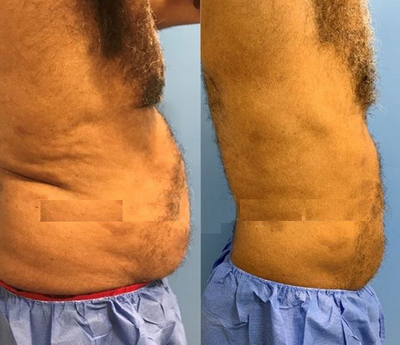 CoolSculpting before and after photo