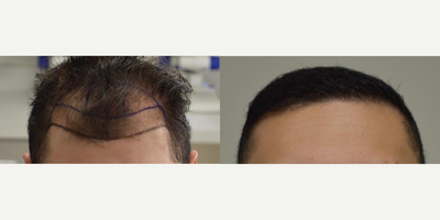 Hair Loss Treatment before and after photo