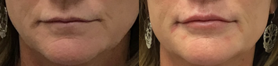 Juvederm before and after photo