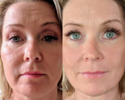 Microneedling before and after photo