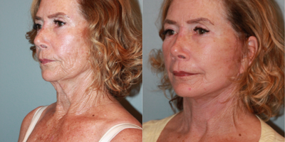 SMAS Facelift before and after photo