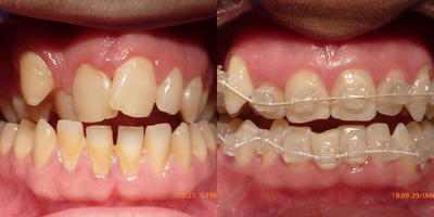 Smile Makeover before and after photo