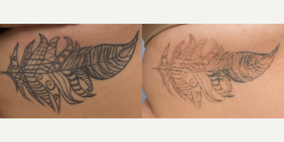 Tattoo Removal before and after photo