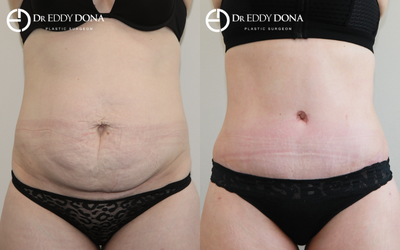 Tummy Tuck before and after photo
