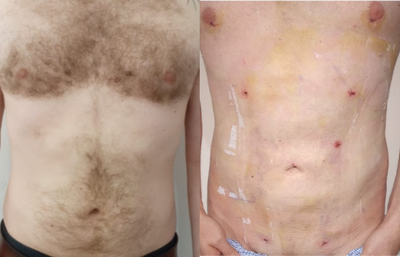 Abdominal Etching before and after photo