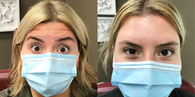 Botox before and after photo