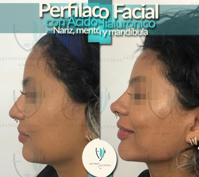 Dermal Fillers before and after photo