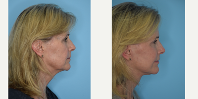 Buccal Fat Removal before and after photo