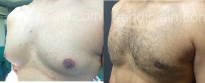 Gynecomastia Surgery before and after photo
