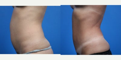 Liposuction before and after photo