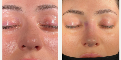 Rhinoplasty before and after photo