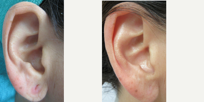 Earlobe Repair before and after photo