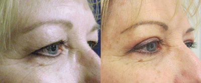 Eyelid Surgery before and after photo