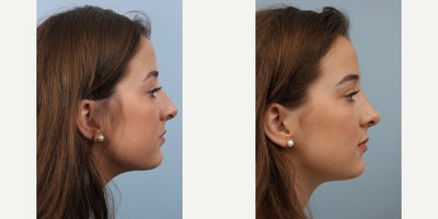 Rhinoplasty before and after photo