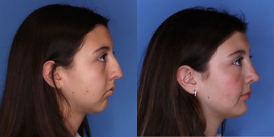 Rhinoplasty before and after photo