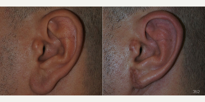 Earlobe Repair before and after photo