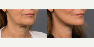 Lower Facelift before and after photo