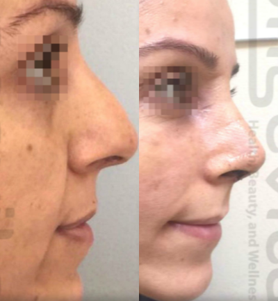 Rhinoplasty before and after photo