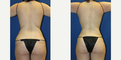 Vaser Liposuction before and after photo