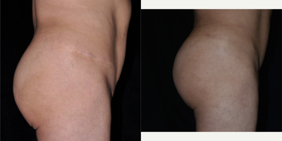 Brazilian Butt Lift before and after photo