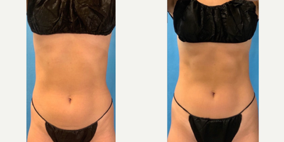 Emsculpt before and after photo