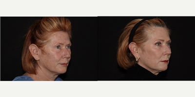 Eyelid Surgery before and after photo
